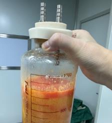 景德镇水动力吸脂手术要做多久？